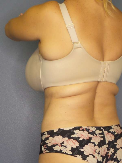 Liposuction Female Before & After Patient #8123