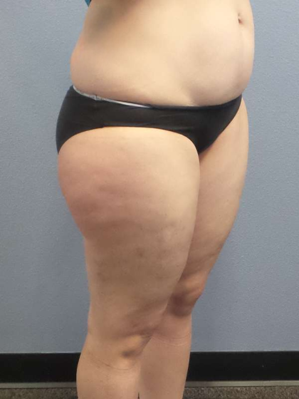 Liposuction Female Before & After Patient #7709