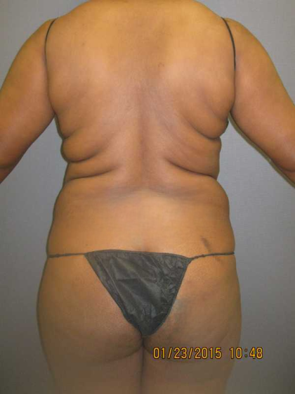 Liposuction Female Before & After Patient #7668