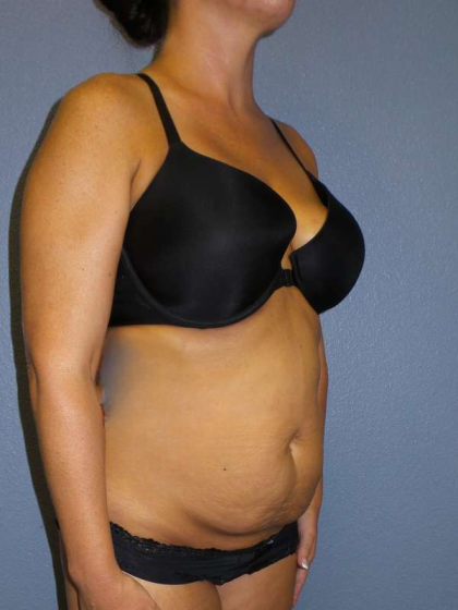 Abdominoplasty Before & After Patient #3775