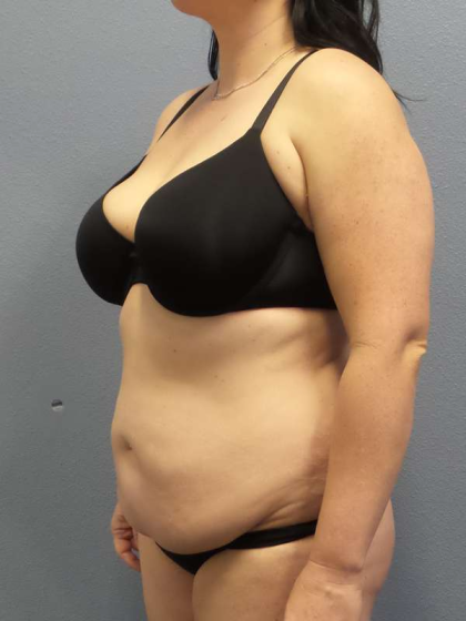 Abdominoplasty Before & After Patient #3550
