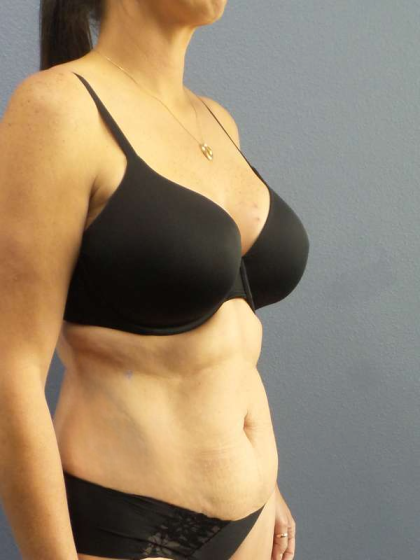 Abdominoplasty Before & After Patient #3471