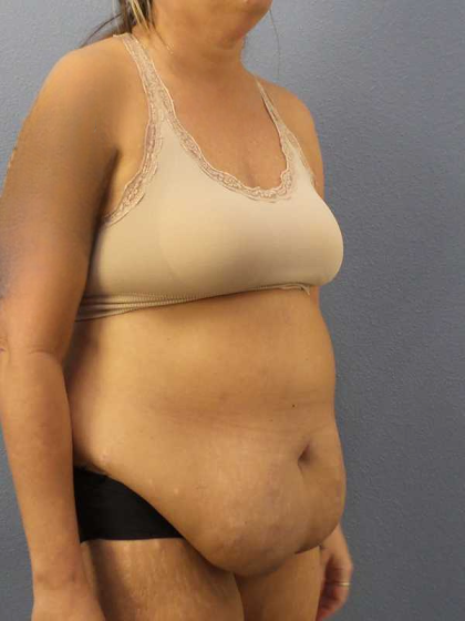 Abdominoplasty Before & After Patient #3594