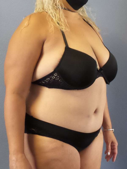 Abdominoplasty Before & After Patient #3437