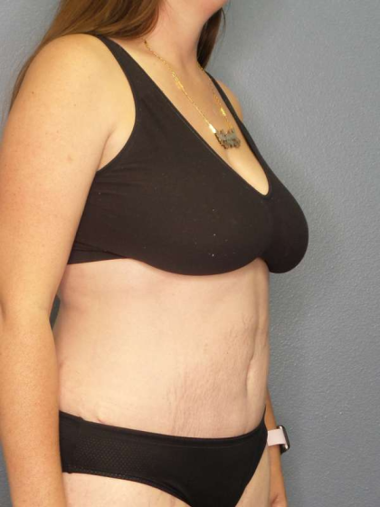 Abdominoplasty Before & After Patient #3409