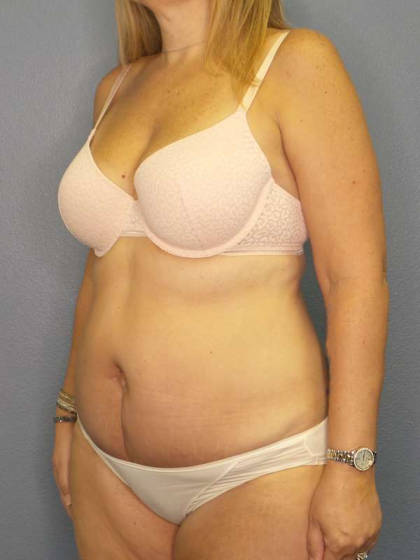 Abdominoplasty Before & After Patient #3350