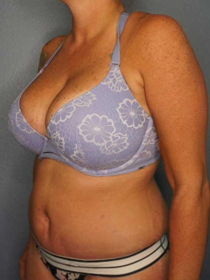 Abdominoplasty Before & After Patient #3272