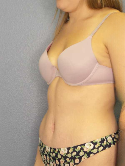 Abdominoplasty Before & After Patient #3236