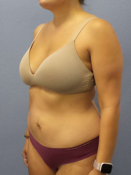 Abdominoplasty Before & After Patient #3225