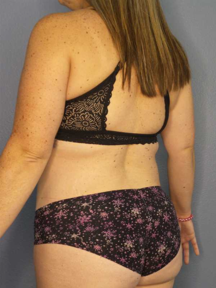 Liposuction Female Before & After Patient #11950