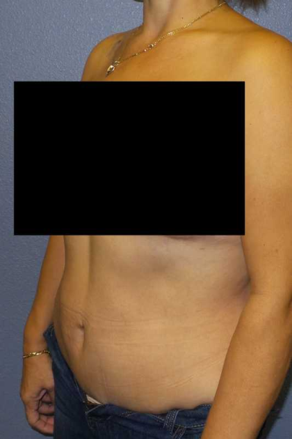 Abdominoplasty Before & After Patient #11131