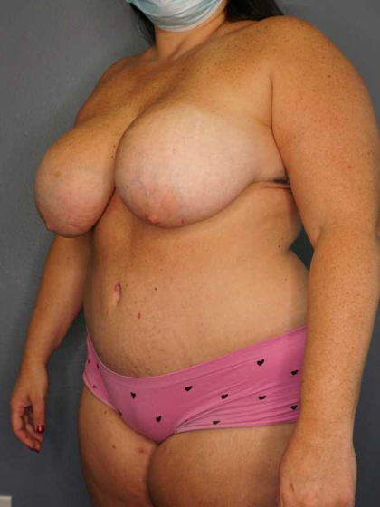 High BMI (Larger Patients) Surgery Before & After Patient #10431