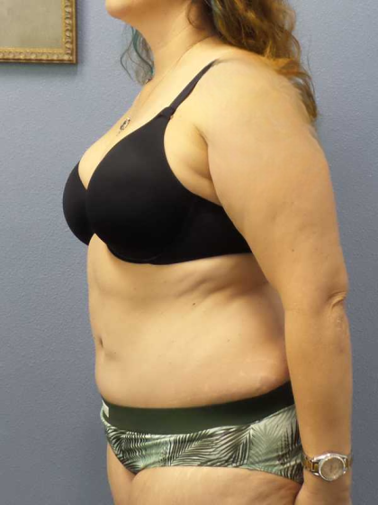 Abdominoplasty Before & After Patient #3188