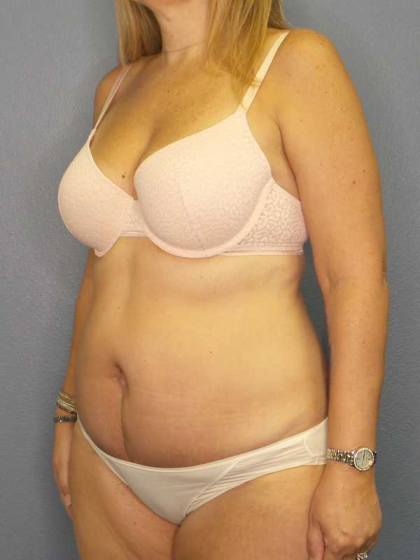 High BMI (Larger Patients) Surgery Before & After Patient #10329