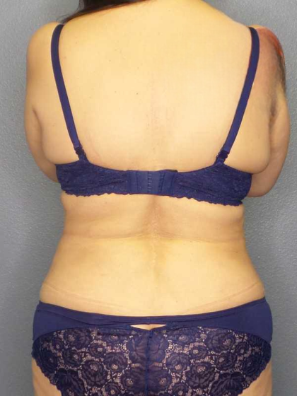 Liposuction Female Before & After Patient #7932