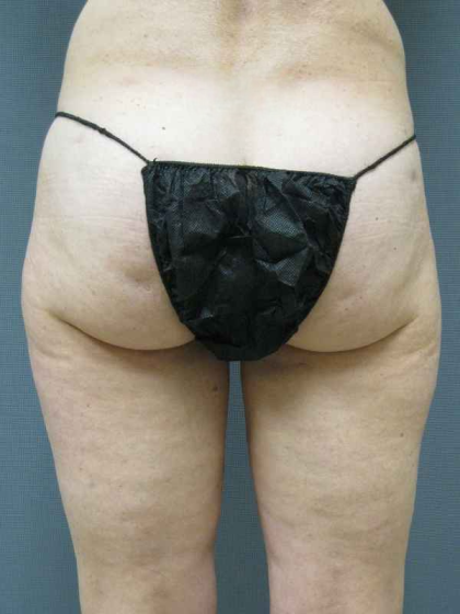 Liposuction Female Before & After Patient #7794