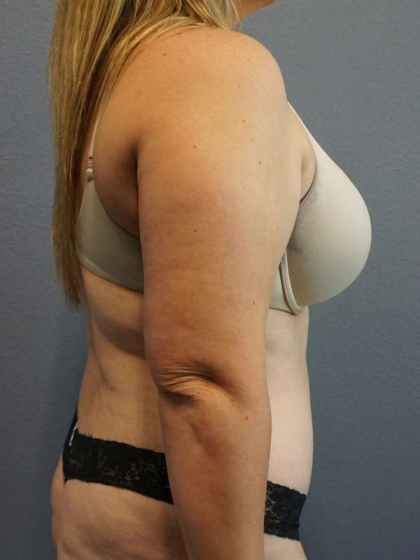 Abdominoplasty Before & After Patient #5197