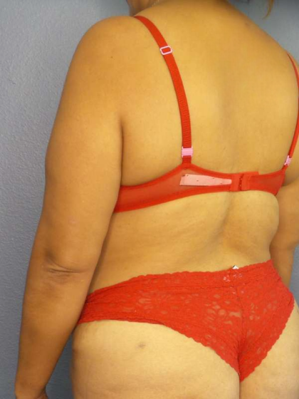 Abdominoplasty Before & After Patient #3638