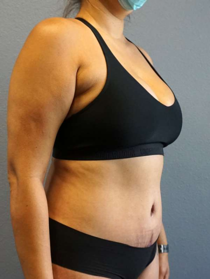 Abdominoplasty Before & After Patient #3583