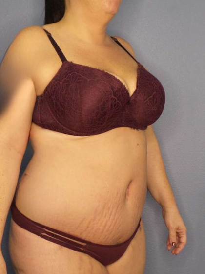 Abdominoplasty Before & After Patient #3572