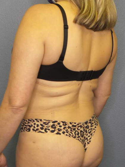 Liposuction Female Before & After Patient #7966
