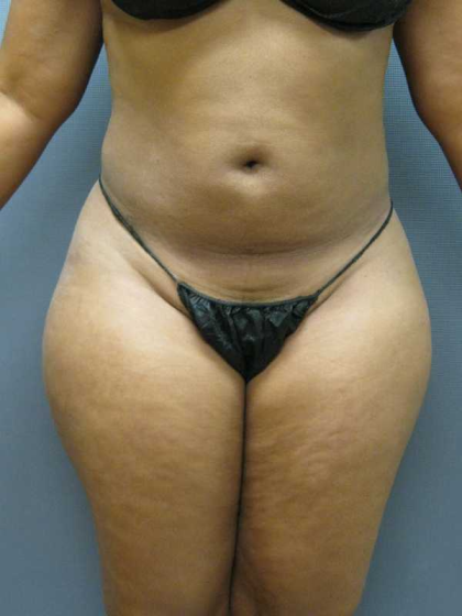 Brazilian Butt Lift Before & After Patient #4903