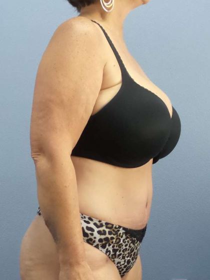 Abdominoplasty Before & After Patient #3786
