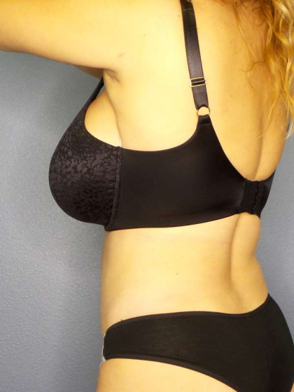 Liposuction Female Before & After Patient #8123