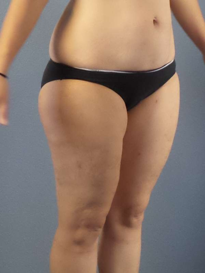 Liposuction Female Before & After Patient #7709