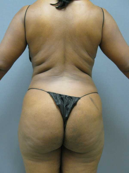 Liposuction Female Before & After Patient #7668