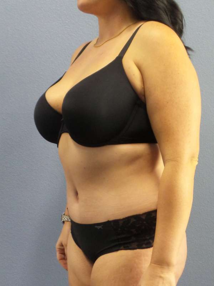 Abdominoplasty Before & After Patient #3550