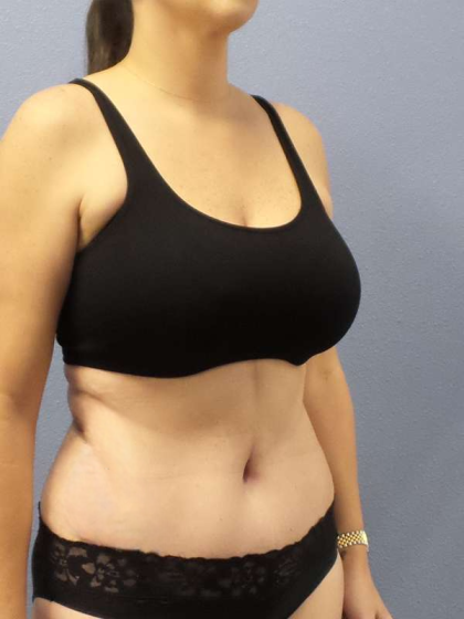 Abdominoplasty Before & After Patient #3471