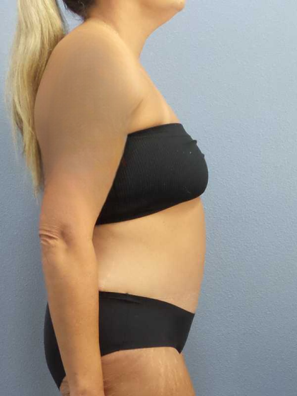Abdominoplasty Before & After Patient #3594