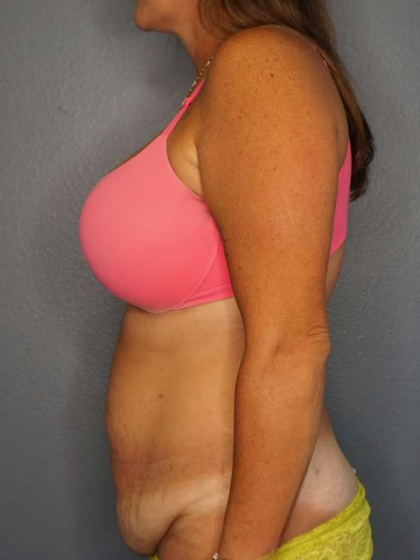 Abdominoplasty Before & After Patient #3272