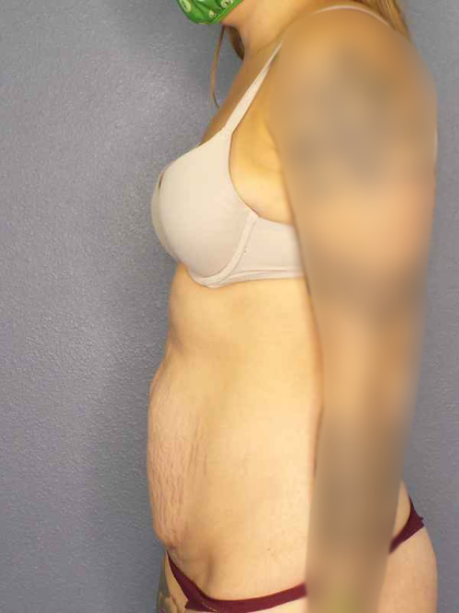 Abdominoplasty Before & After Patient #3236