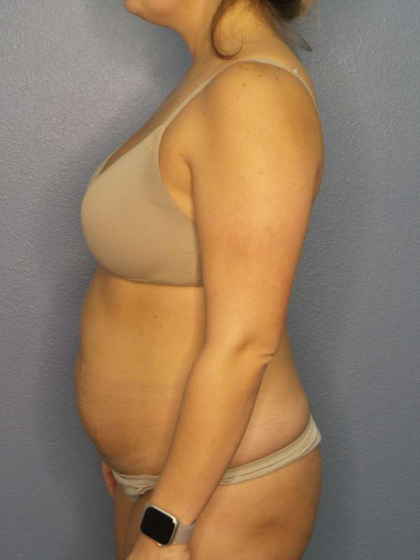 Abdominoplasty Before & After Patient #3225
