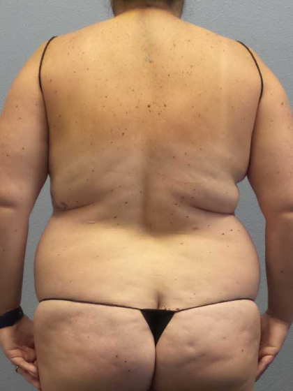 Liposuction Female Before & After Patient #11950