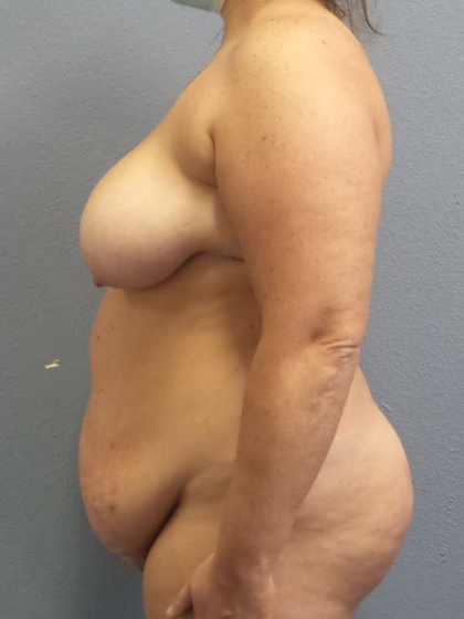 High BMI (Larger Patients) Surgery Before & After Patient #10431