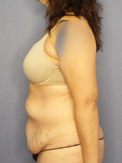 Abdominoplasty Before & After Patient #3188