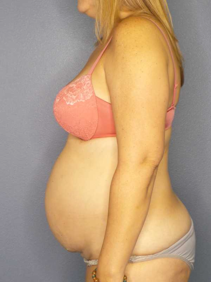 High BMI (Larger Patients) Surgery Before & After Patient #10329