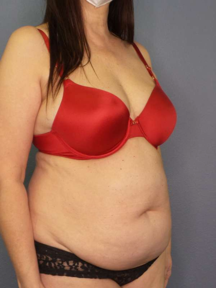 Liposuction Female Before & After Patient #7932