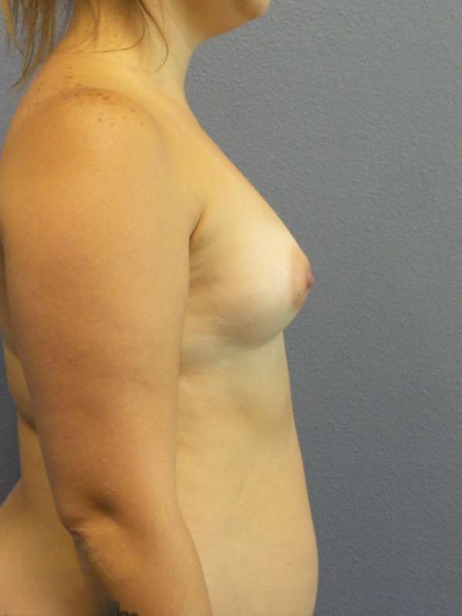 High BMI (Larger Patients) Surgery Before & After Patient #6042