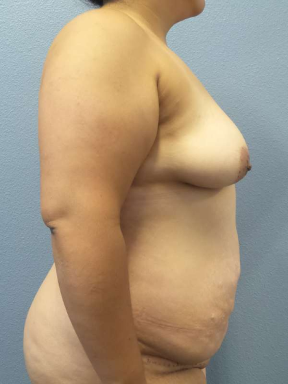 Abdominoplasty Before & After Patient #3735