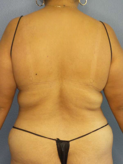 Abdominoplasty Before & After Patient #3638