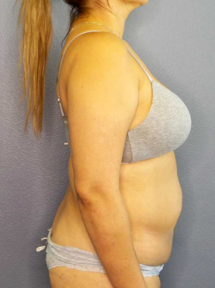 Abdominoplasty Before & After Patient #3583