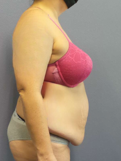 Abdominoplasty Before & After Patient #3572