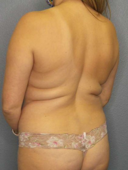 Liposuction Female Before & After Patient #7966