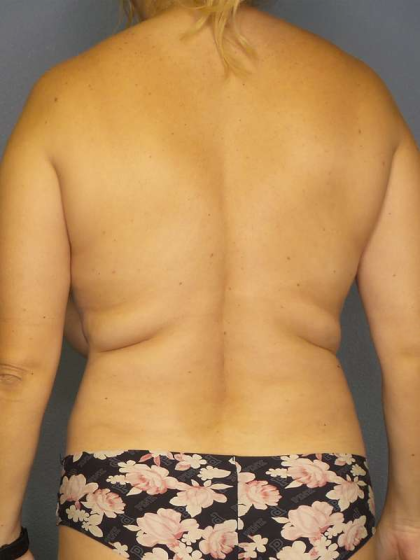 Liposuction Female Before & After Patient #8123