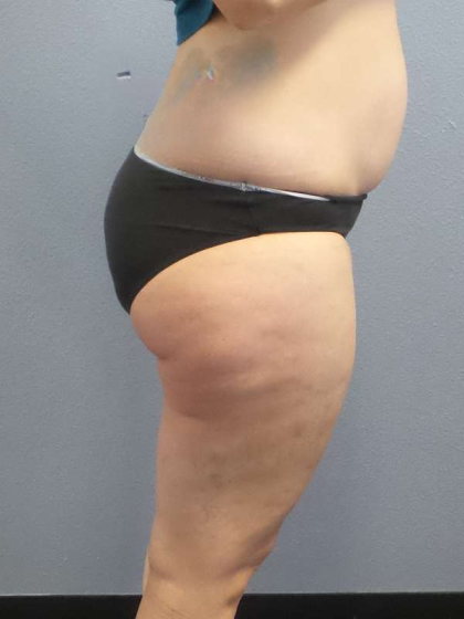 Liposuction Female Before & After Patient #7709