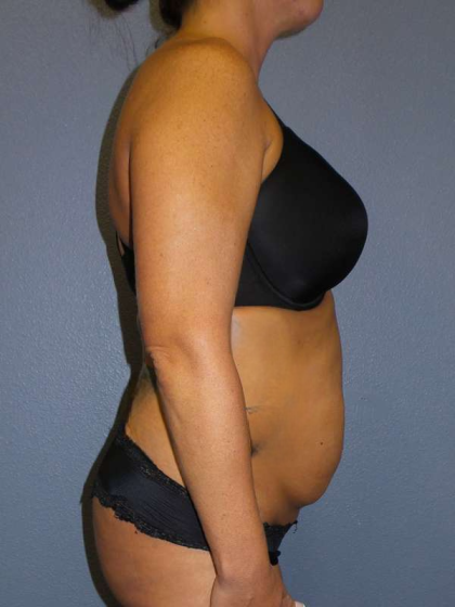 Abdominoplasty Before & After Patient #3775